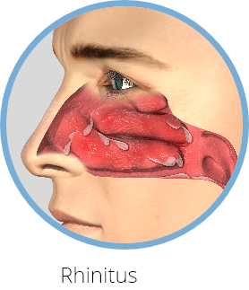 post nasal drip without runny nose post nasal drip without runny nose
